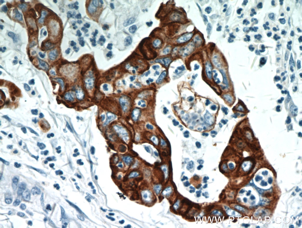 Immunohistochemistry (IHC) staining of human pancreas cancer tissue using Cytokeratin 18 Polyclonal antibody (10830-1-AP)