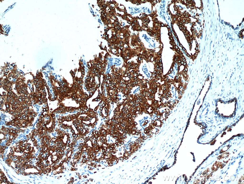 Immunohistochemistry (IHC) staining of human prostate cancer tissue using Cytokeratin 18 Polyclonal antibody (10830-1-AP)