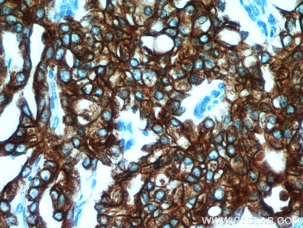 Immunohistochemistry (IHC) staining of human prostate cancer tissue using Cytokeratin 18 Polyclonal antibody (10830-1-AP)