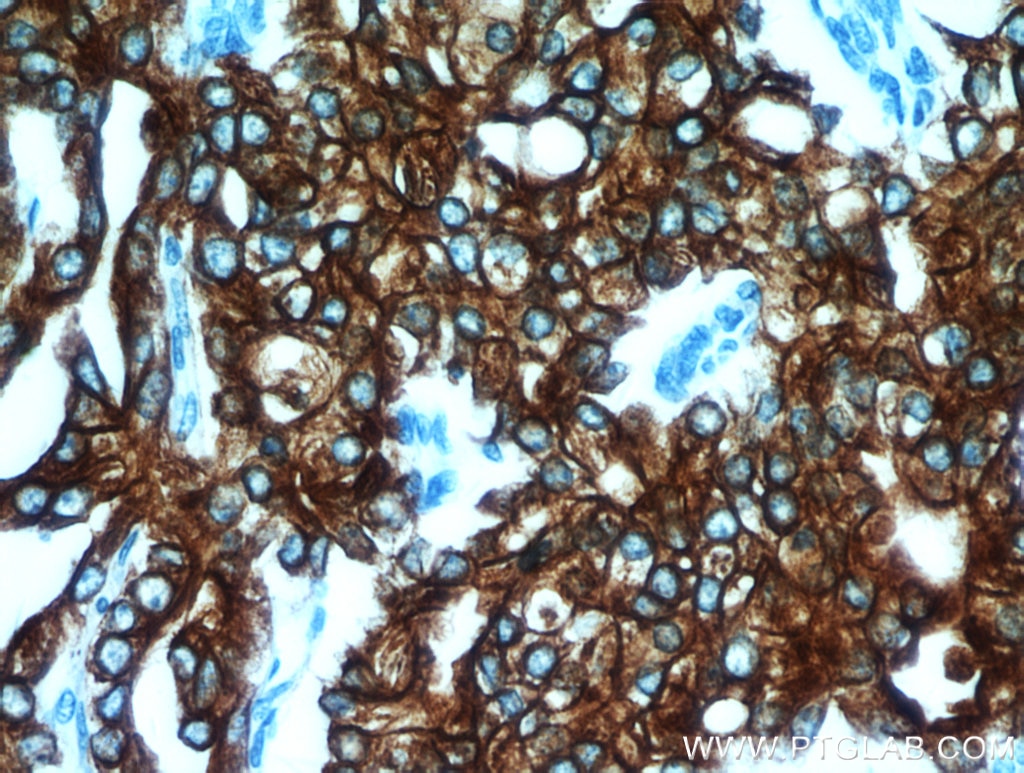 IHC staining of human prostate cancer using 10830-1-AP