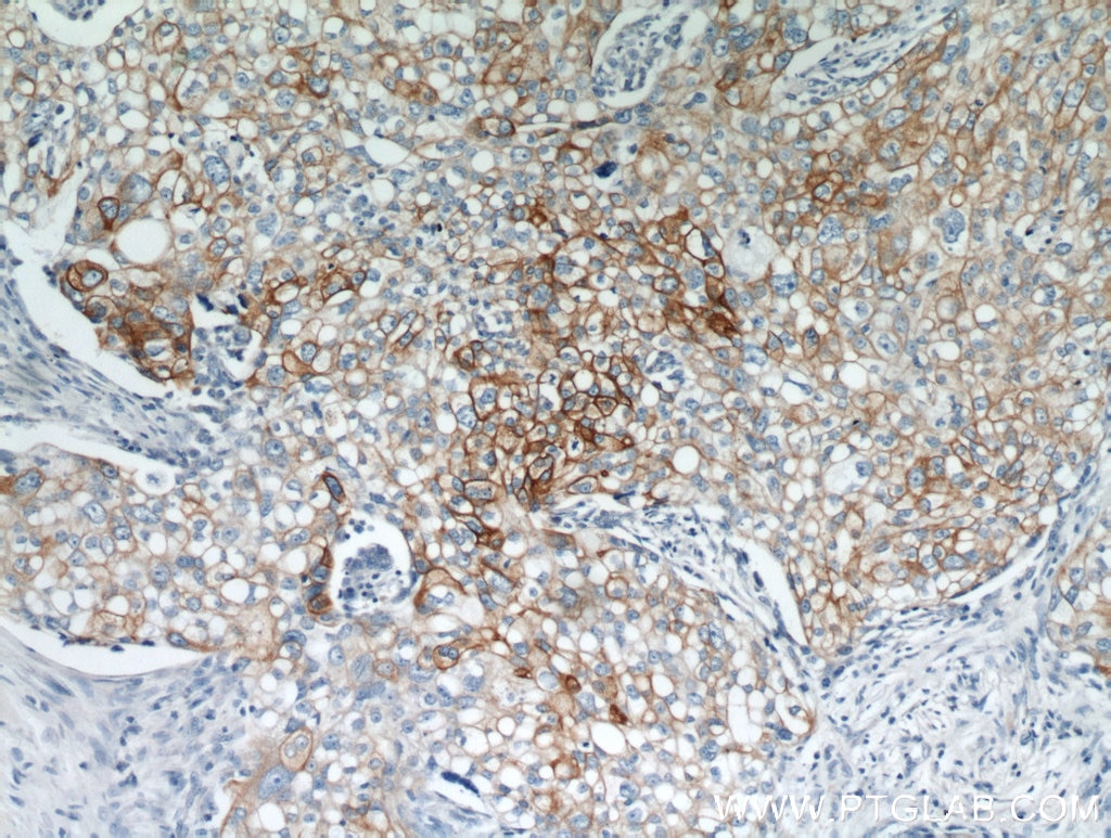 IHC staining of human ovary tumor using 10830-1-AP