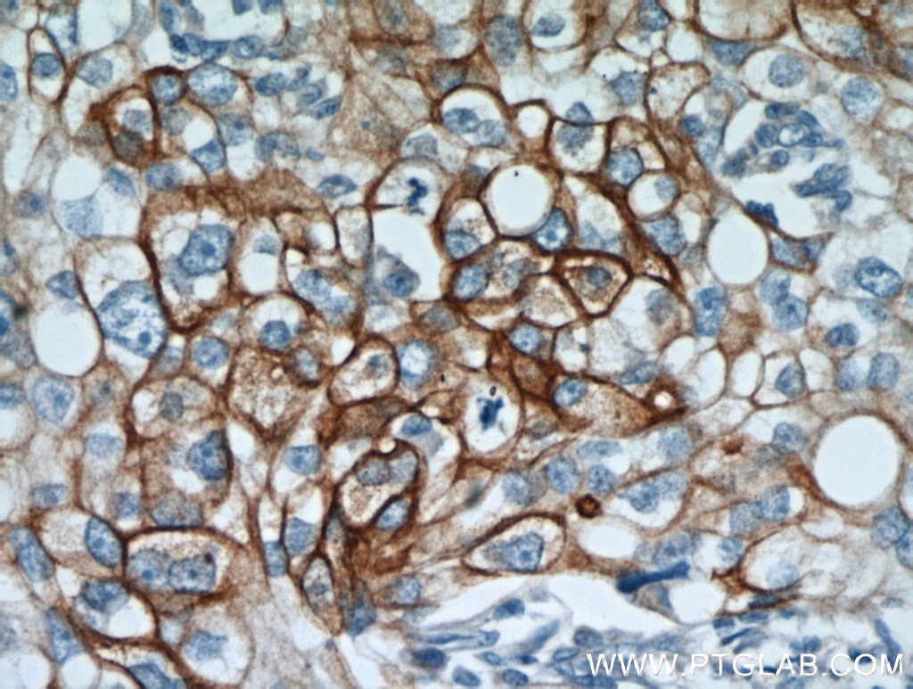 Immunohistochemistry (IHC) staining of human ovary tumor tissue using Cytokeratin 18 Polyclonal antibody (10830-1-AP)