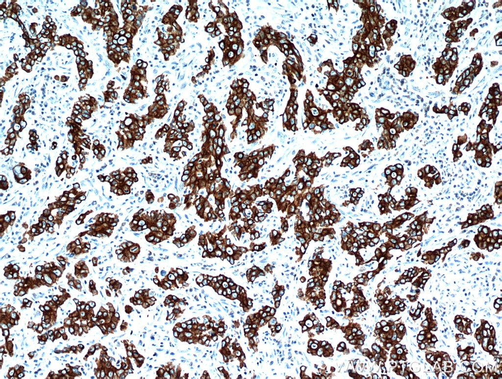 Immunohistochemistry (IHC) staining of human stomach cancer tissue using Cytokeratin 18 Polyclonal antibody (10830-1-AP)