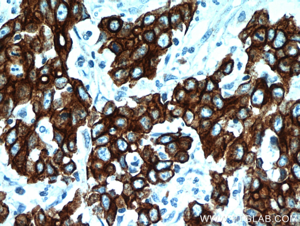 Immunohistochemistry (IHC) staining of human stomach cancer tissue using Cytokeratin 18 Polyclonal antibody (10830-1-AP)