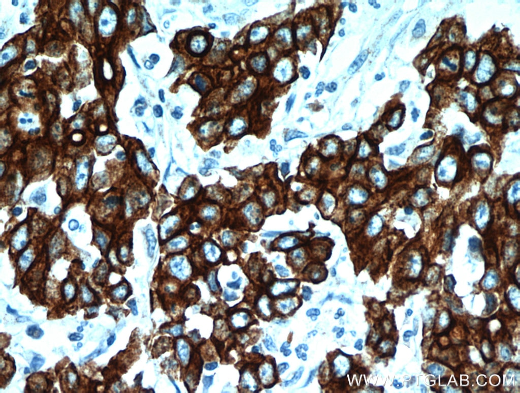 IHC staining of human stomach cancer using 10830-1-AP