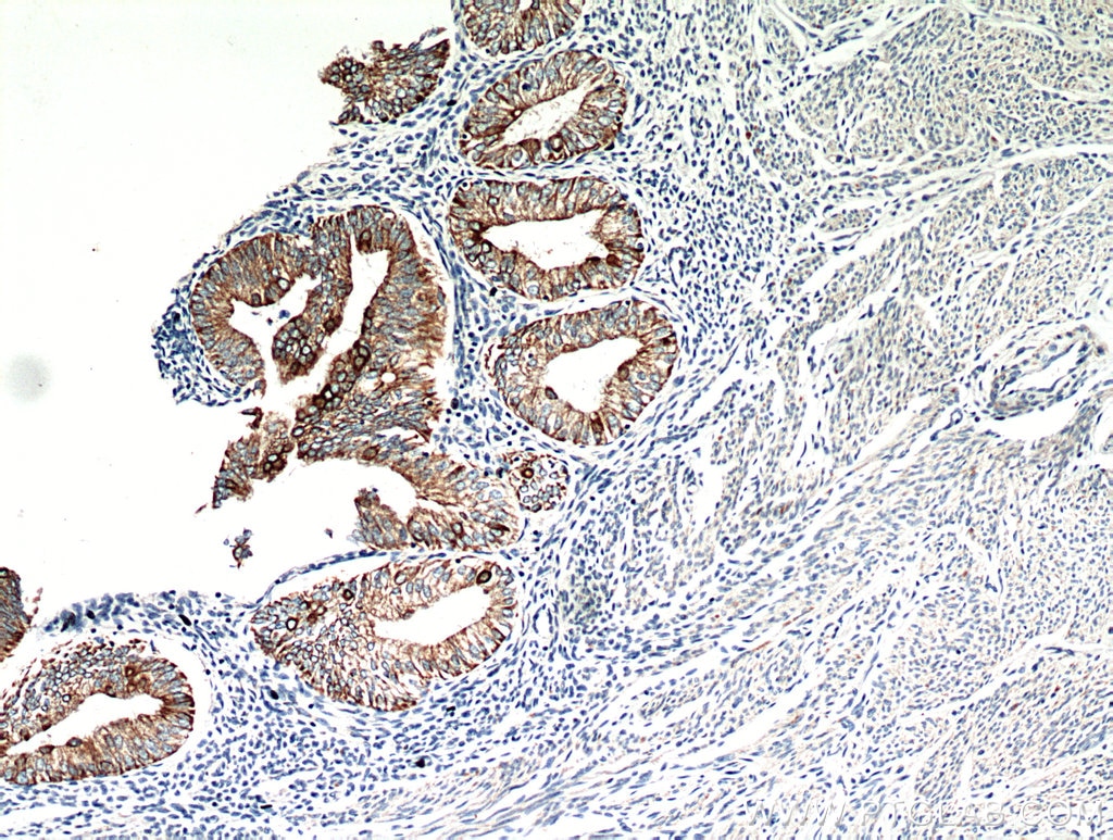 Immunohistochemistry (IHC) staining of human endometrial cancer tissue using Cytokeratin 18 Polyclonal antibody (10830-1-AP)