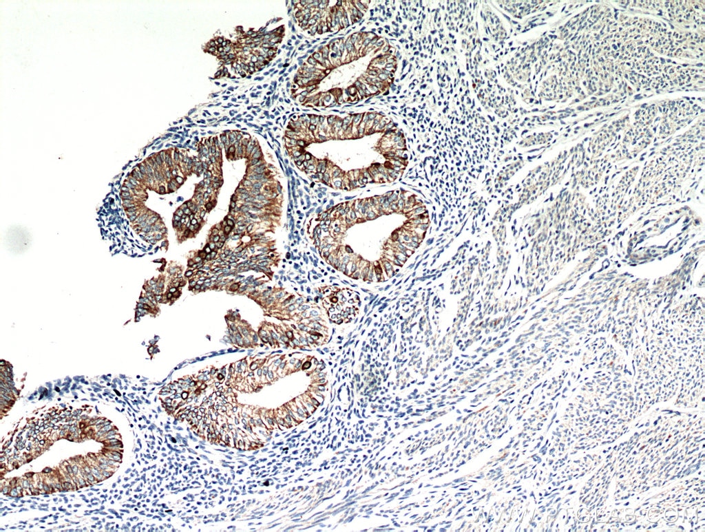 IHC staining of human endometrial cancer using 10830-1-AP