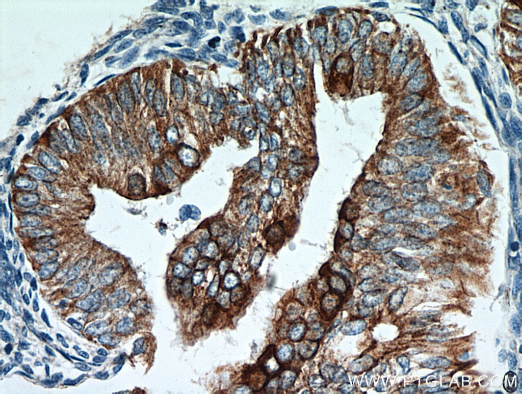 Immunohistochemistry (IHC) staining of human endometrial cancer tissue using Cytokeratin 18 Polyclonal antibody (10830-1-AP)