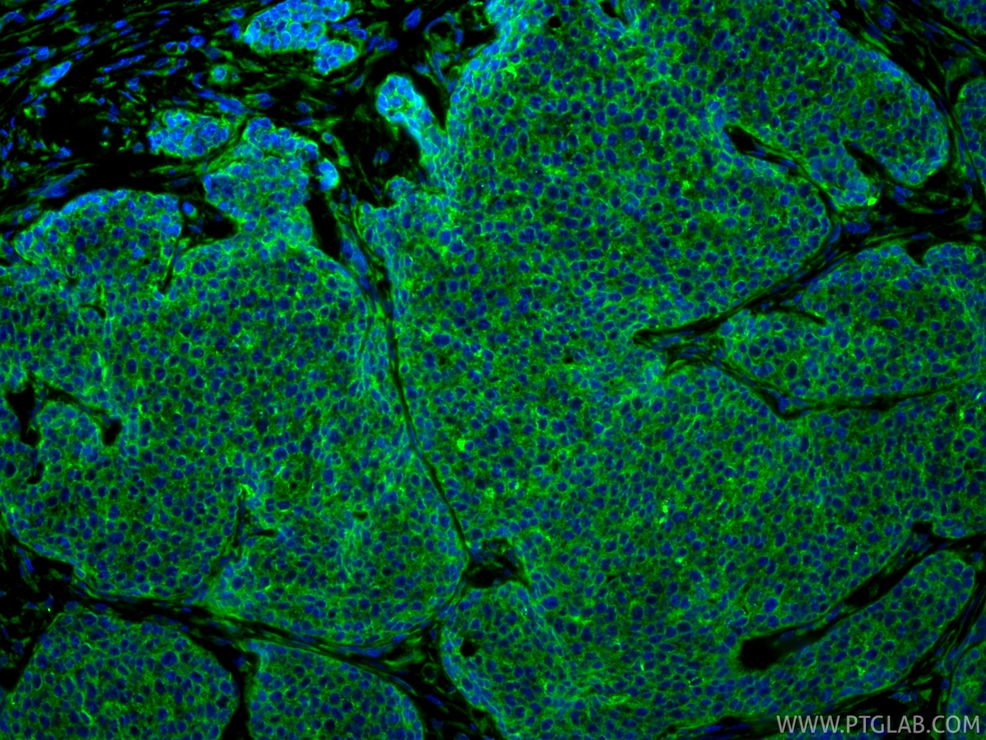 Immunofluorescence (IF) / fluorescent staining of human breast cancer tissue using Cytokeratin 18 Polyclonal antibody (18708-1-AP)