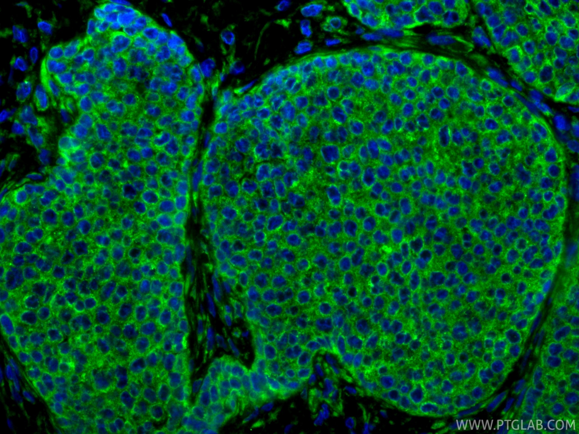 Immunofluorescence (IF) / fluorescent staining of human breast cancer tissue using Cytokeratin 18 Polyclonal antibody (18708-1-AP)