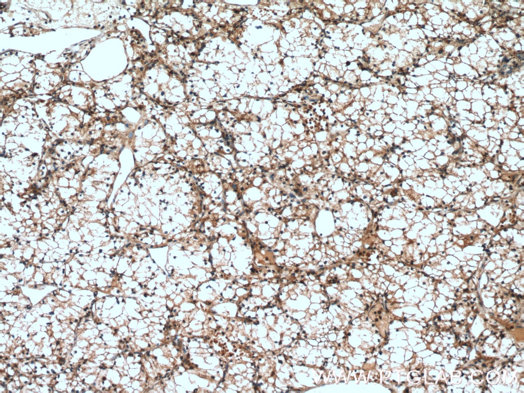 Immunohistochemistry (IHC) staining of human renal cell carcinoma tissue using Cytokeratin 18 Polyclonal antibody (18708-1-AP)