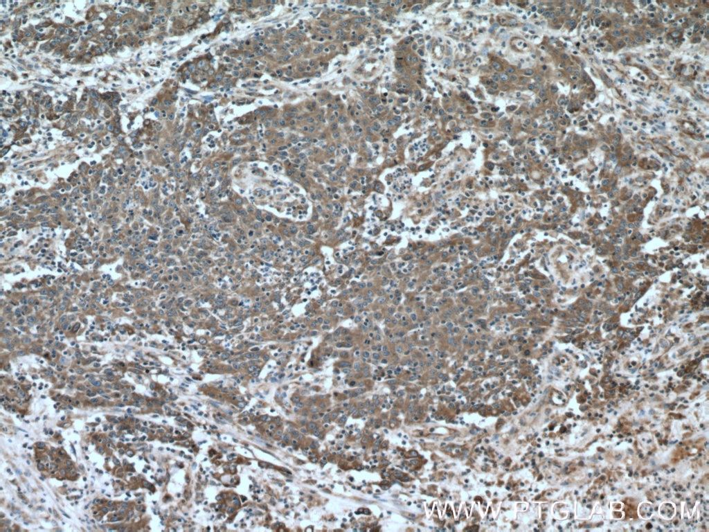 Immunohistochemistry (IHC) staining of human colon cancer tissue using Cytokeratin 18 Polyclonal antibody (18708-1-AP)