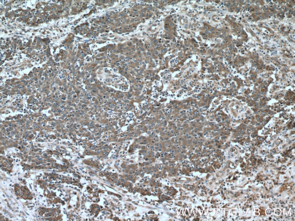 IHC staining of human colon cancer using 18708-1-AP