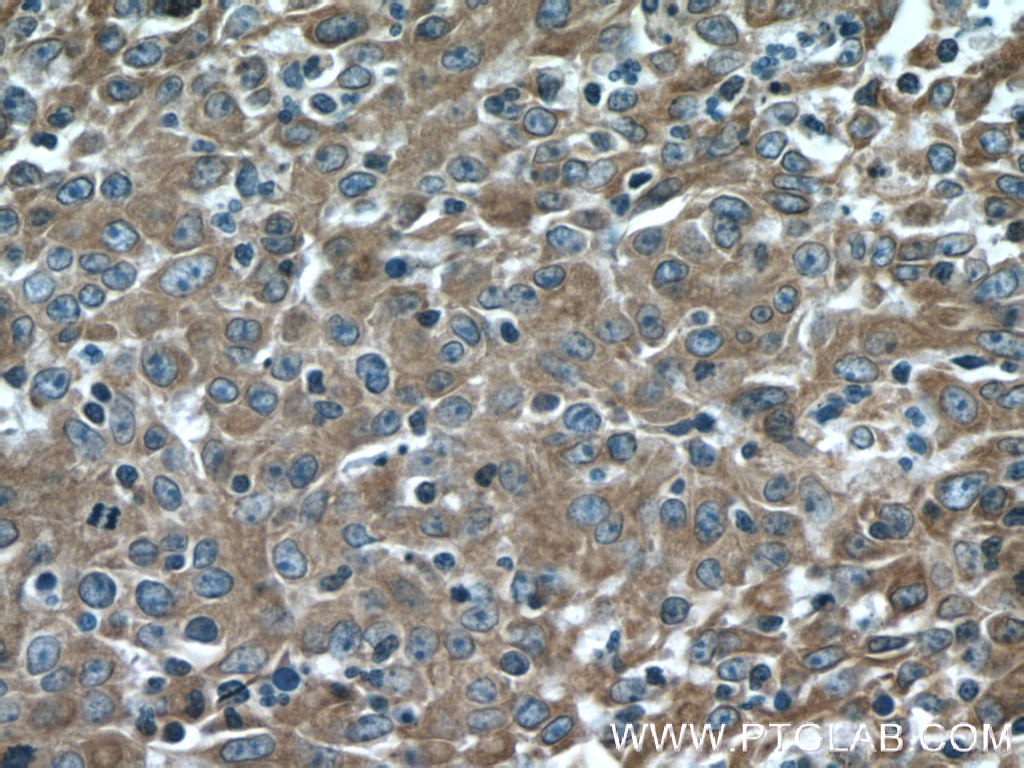 IHC staining of human colon cancer using 18708-1-AP