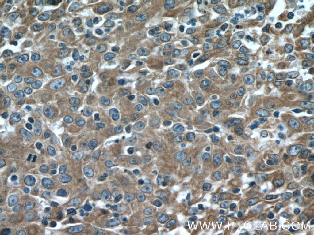 Immunohistochemistry (IHC) staining of human colon cancer tissue using Cytokeratin 18 Polyclonal antibody (18708-1-AP)