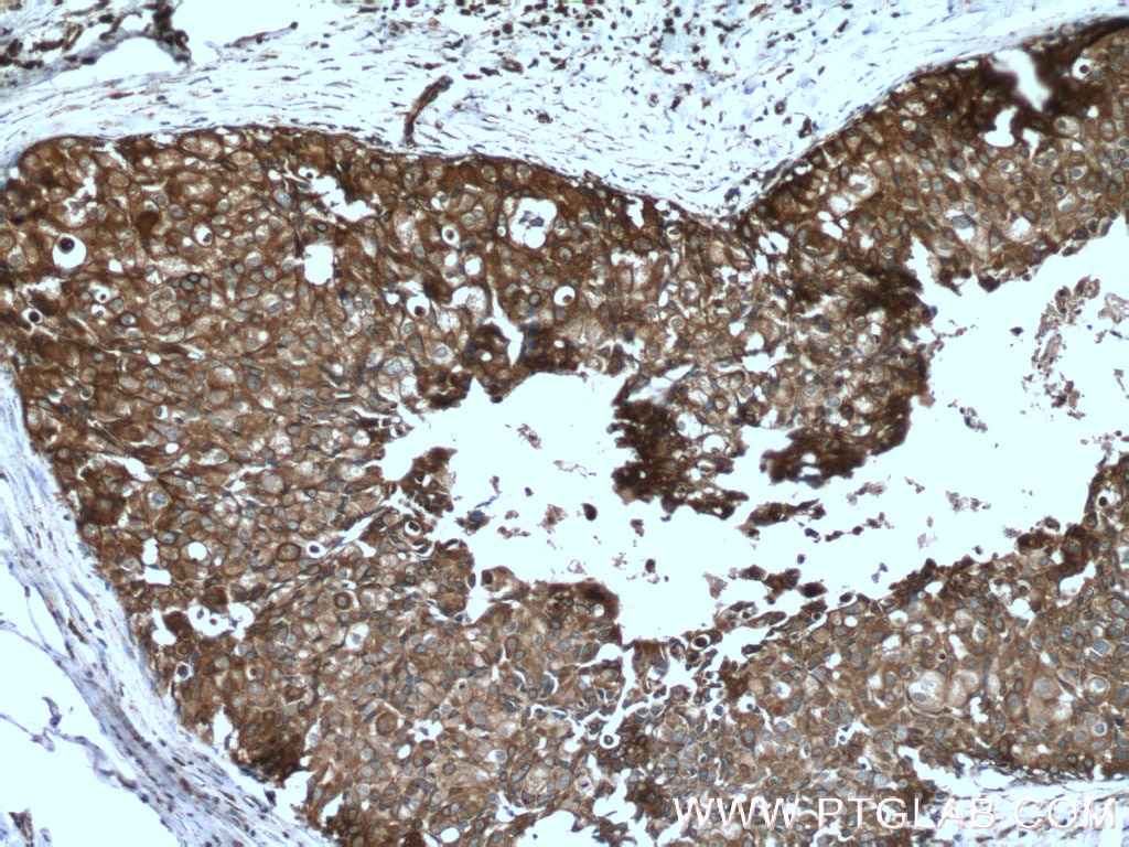 Immunohistochemistry (IHC) staining of human breast cancer tissue using Cytokeratin 18 Polyclonal antibody (18708-1-AP)