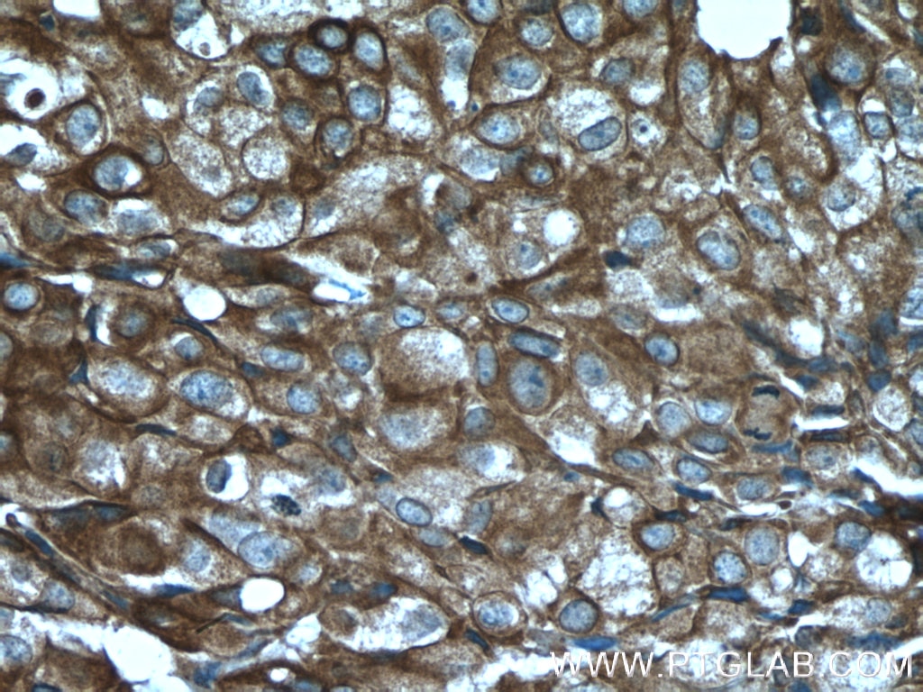 Immunohistochemistry (IHC) staining of human breast cancer tissue using Cytokeratin 18 Polyclonal antibody (18708-1-AP)