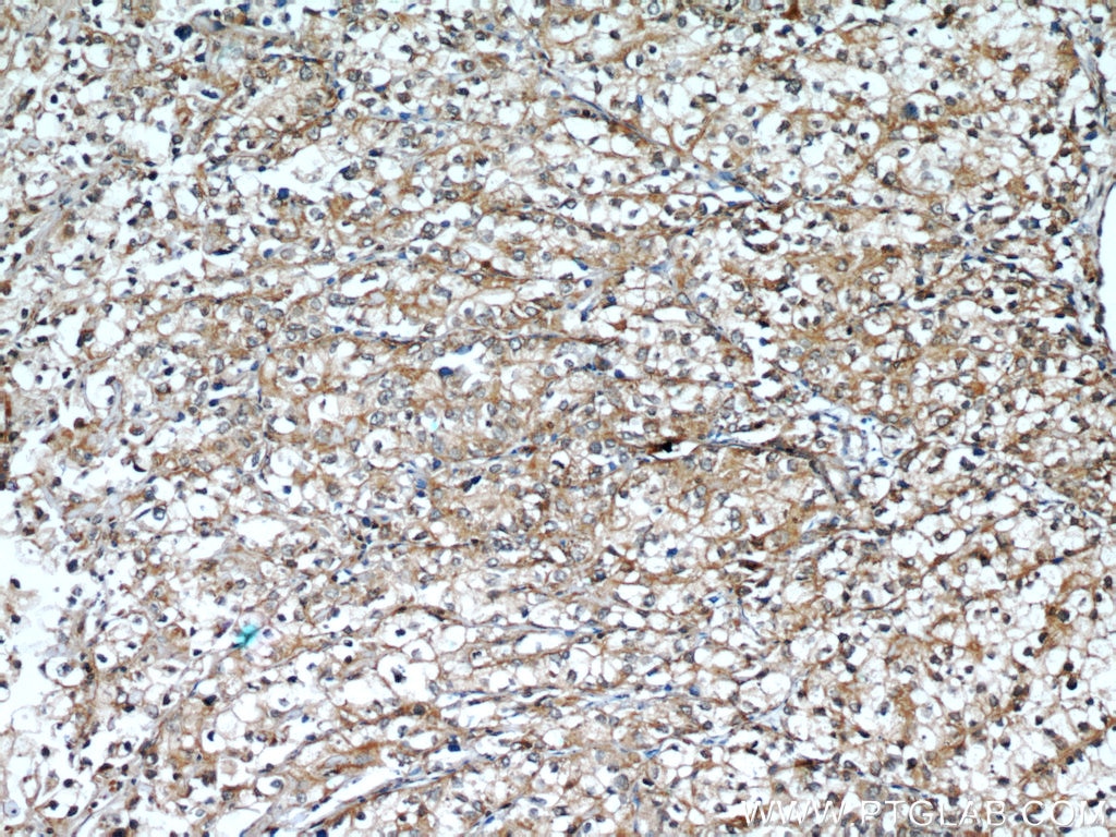 Immunohistochemistry (IHC) staining of human endometrial cancer tissue using Cytokeratin 18 Polyclonal antibody (18708-1-AP)