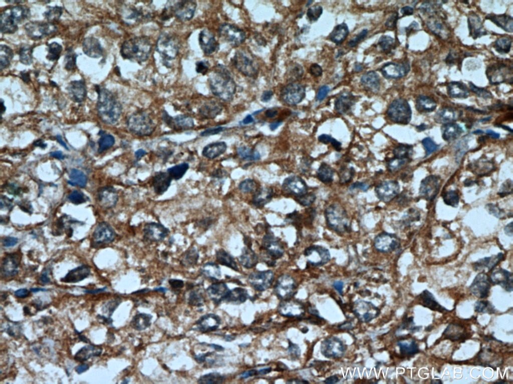 Immunohistochemistry (IHC) staining of human endometrial cancer tissue using Cytokeratin 18 Polyclonal antibody (18708-1-AP)