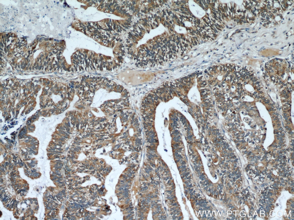 Immunohistochemistry (IHC) staining of human ovary tumor tissue using Cytokeratin 18 Polyclonal antibody (18708-1-AP)