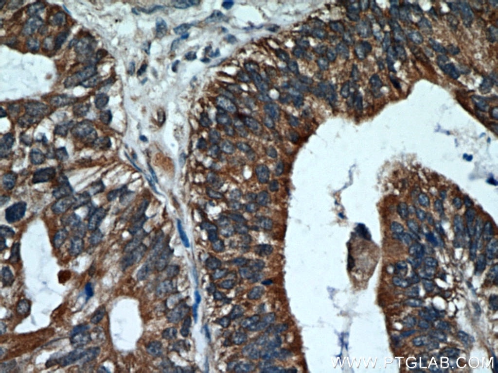 IHC staining of human ovary tumor using 18708-1-AP