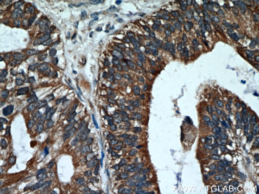 Immunohistochemistry (IHC) staining of human ovary tumor tissue using Cytokeratin 18 Polyclonal antibody (18708-1-AP)