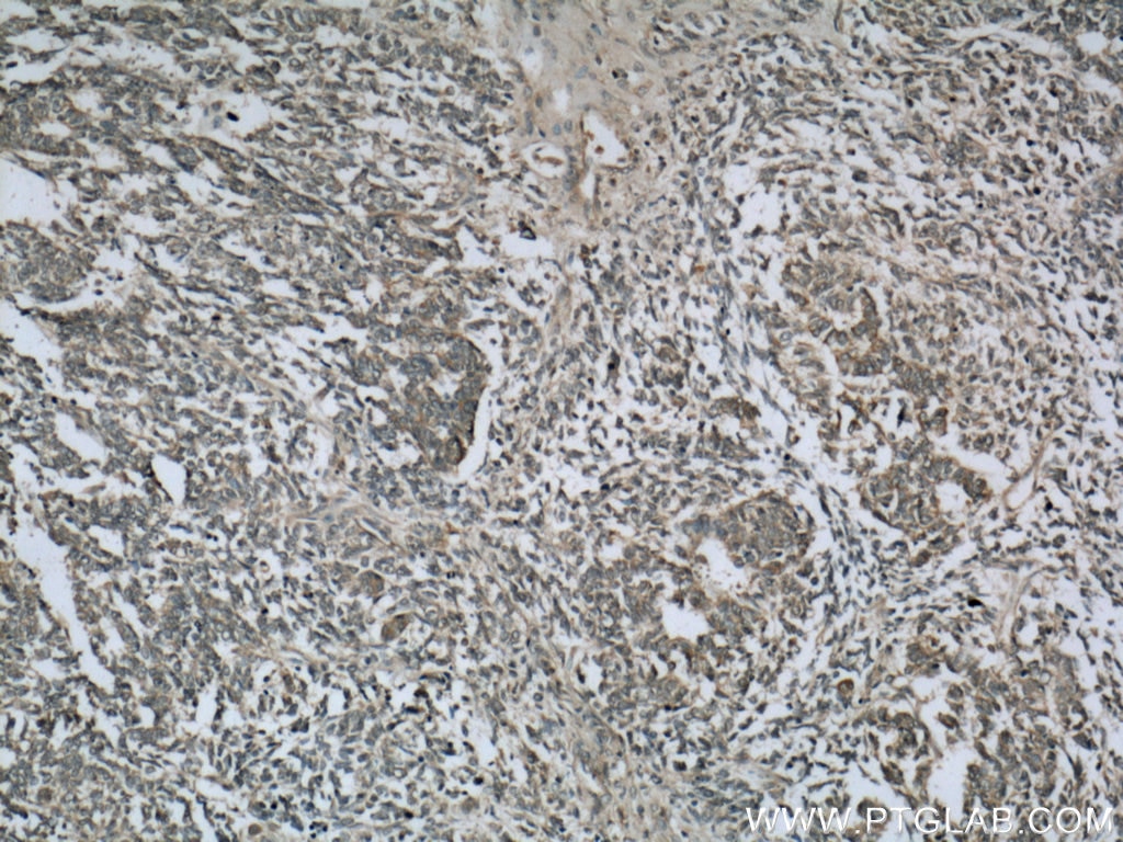 Immunohistochemistry (IHC) staining of human nephroblastoma tissue using Cytokeratin 18 Polyclonal antibody (18708-1-AP)