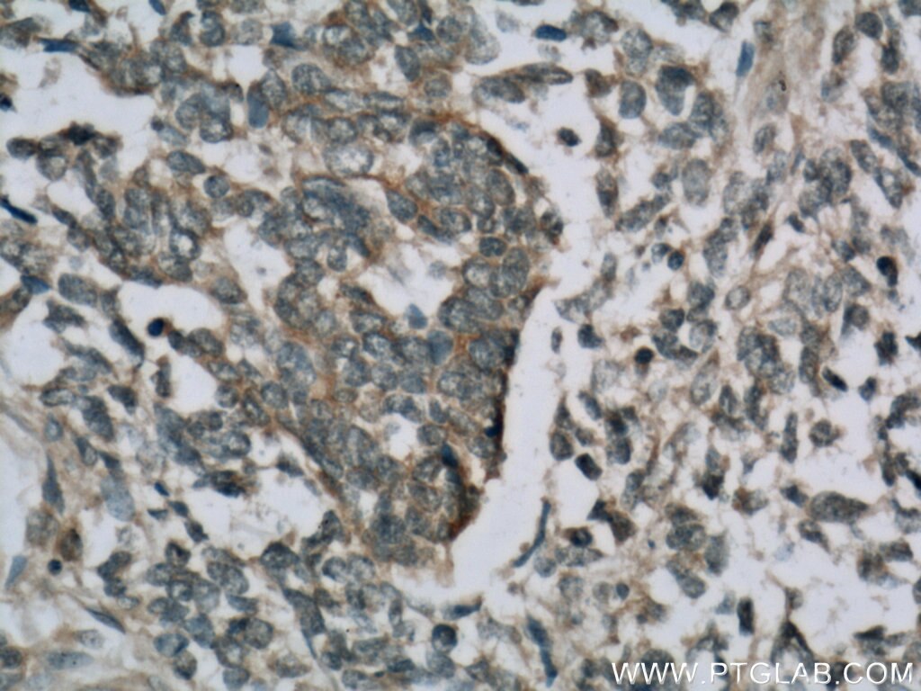 Immunohistochemistry (IHC) staining of human nephroblastoma tissue using Cytokeratin 18 Polyclonal antibody (18708-1-AP)