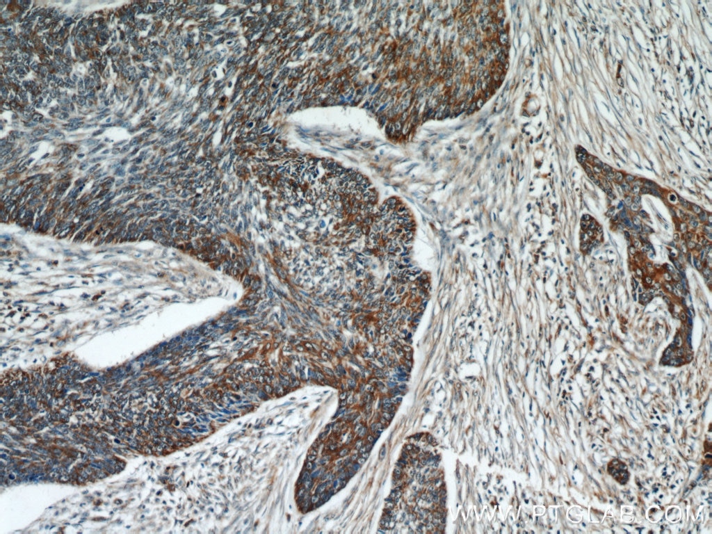 Immunohistochemistry (IHC) staining of human skin cancer tissue using Cytokeratin 18 Polyclonal antibody (18708-1-AP)