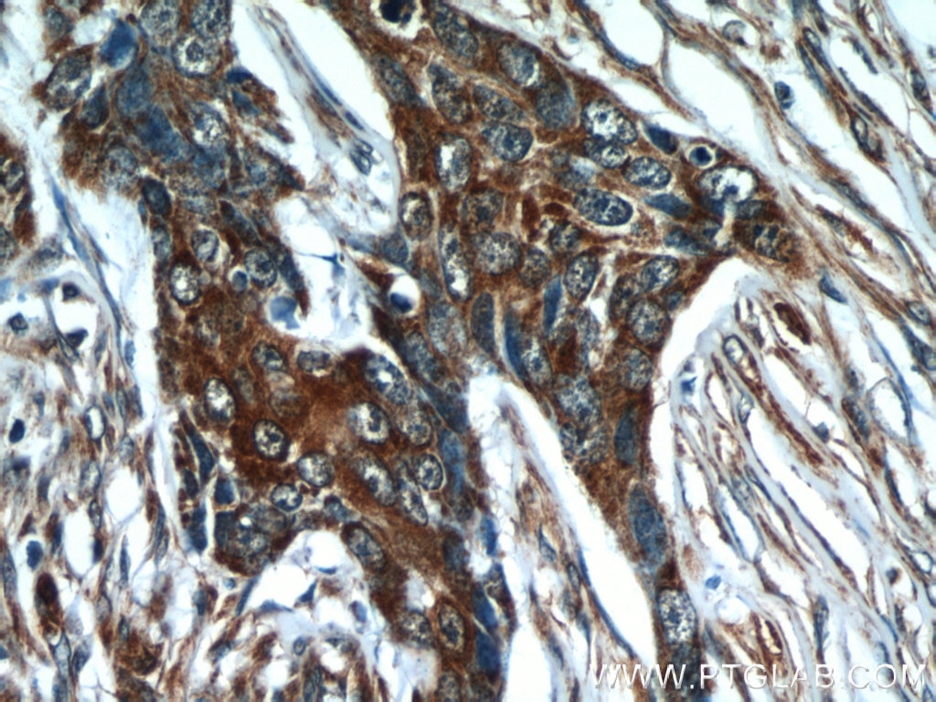 Immunohistochemistry (IHC) staining of human skin cancer tissue using Cytokeratin 18 Polyclonal antibody (18708-1-AP)