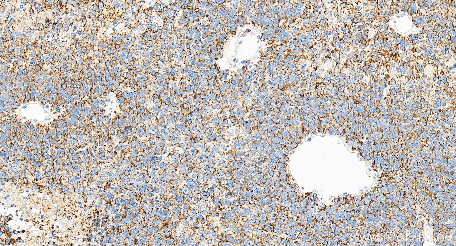 Immunohistochemical analysis of paraffin-embedded human hepatocellular carcinoma slide using 66187-1-Ig (Cytokeratin 18 antibody) at dilution of 1:2000 (under 20x lens). Heat mediated antigen retrieval with Tris-EDTA buffer (pH 9.0). Immunohistochemistry (IHC) staining of human hepatocellular carcinoma using Cytokeratin 18 Monoclonal antibody (66187-1-Ig)