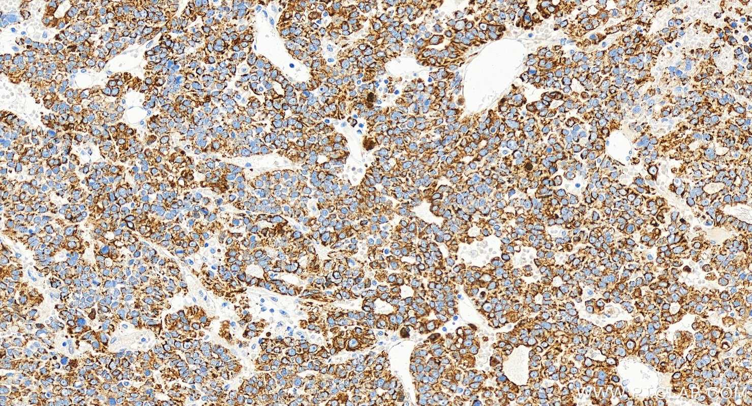 Immunohistochemical analysis of paraffin-embedded human hepatocellular carcinoma slide using 66187-1-Ig (Cytokeratin 18 antibody) at dilution of 1:2000 (under 20x lens). Heat mediated antigen retrieval with Tris-EDTA buffer (pH 9.0). Immunohistochemistry (IHC) staining of human hepatocellular carcinoma using Cytokeratin 18 Monoclonal antibody (66187-1-Ig)