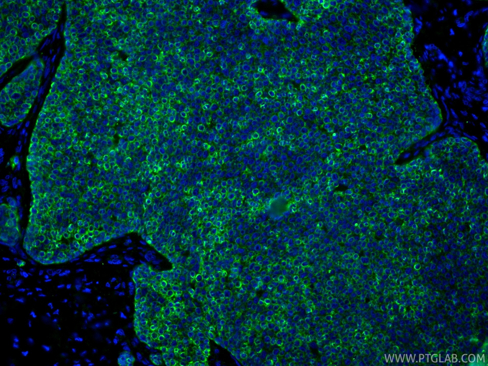 Immunofluorescence (IF) / fluorescent staining of human breast cancer tissue using Cytokeratin 18 Monoclonal antibody (66187-1-Ig)