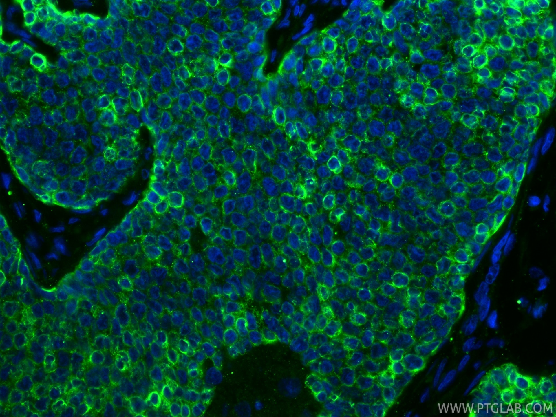 Immunofluorescence (IF) / fluorescent staining of human breast cancer tissue using Cytokeratin 18 Monoclonal antibody (66187-1-Ig)