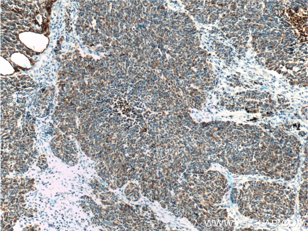 Immunohistochemistry (IHC) staining of human lung cancer tissue using Cytokeratin 18 Monoclonal antibody (66187-1-Ig)