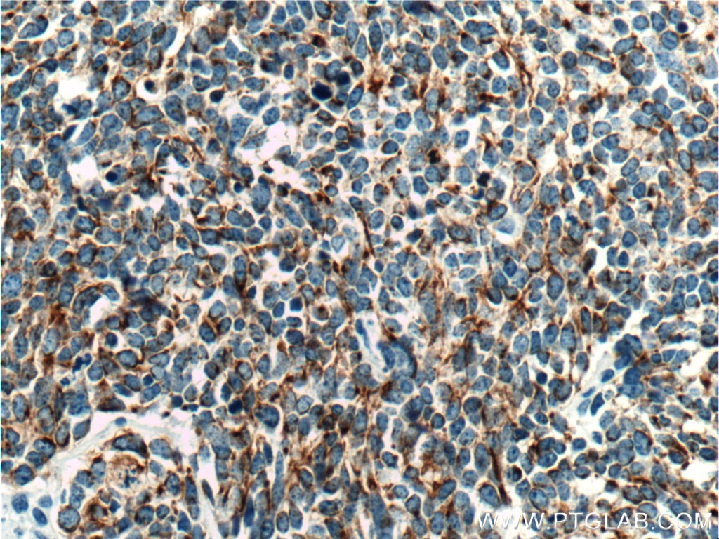 Immunohistochemistry (IHC) staining of human lung cancer tissue using Cytokeratin 18 Monoclonal antibody (66187-1-Ig)