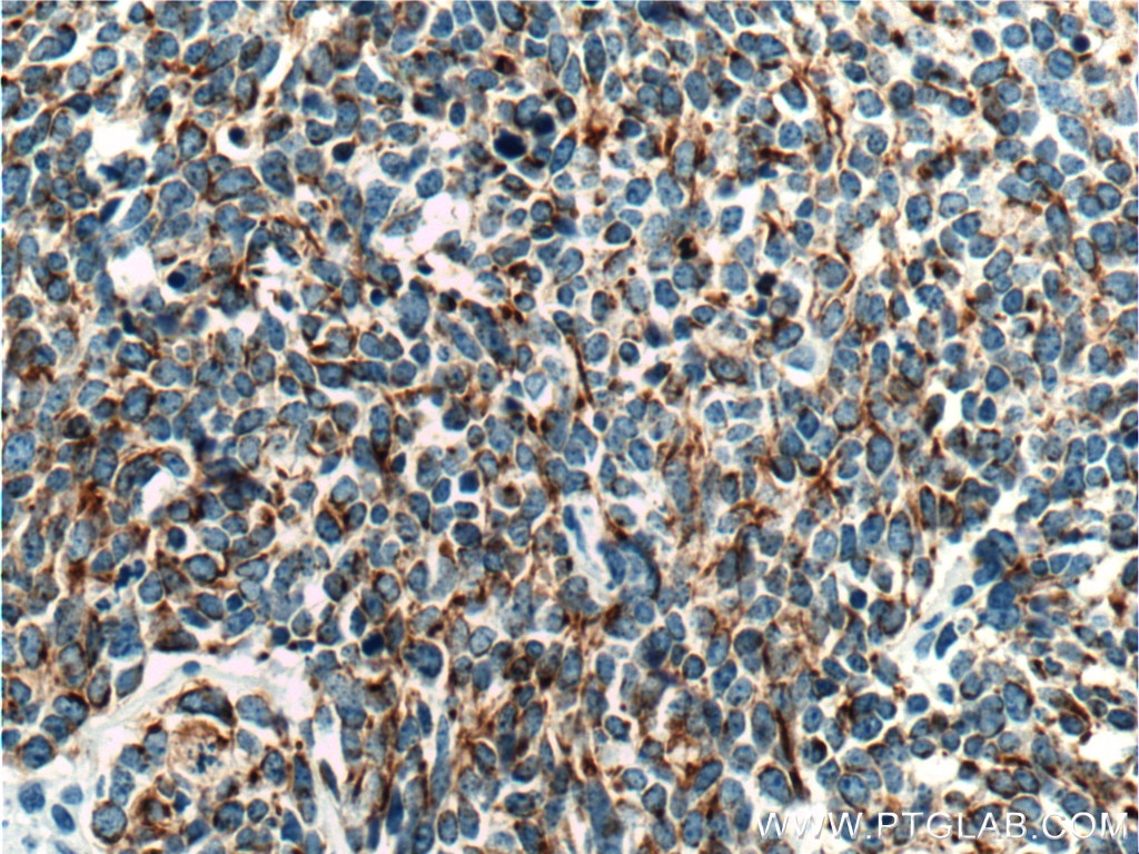 IHC staining of human lung cancer using 66187-1-Ig