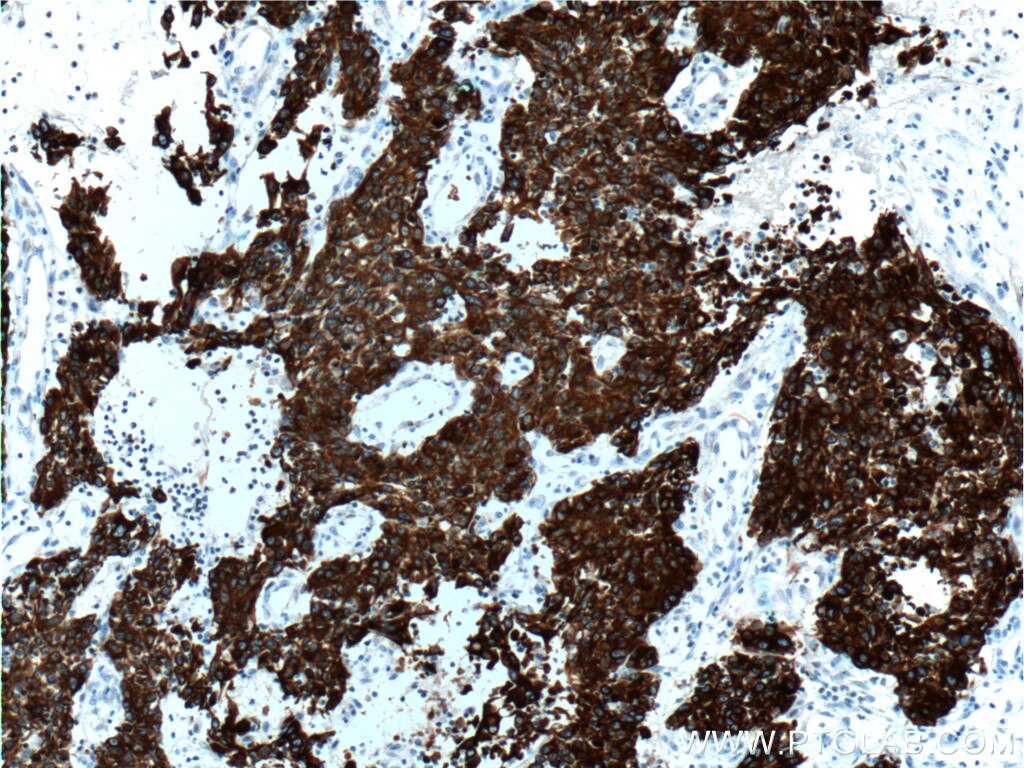 Immunohistochemistry (IHC) staining of human colon cancer tissue using Cytokeratin 18 Monoclonal antibody (66187-1-Ig)