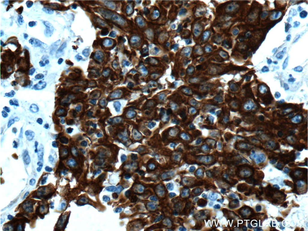 Immunohistochemistry (IHC) staining of human colon cancer tissue using Cytokeratin 18 Monoclonal antibody (66187-1-Ig)