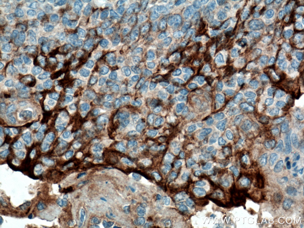 Immunohistochemistry (IHC) staining of human tonsillitis tissue using Cytokeratin 18 Monoclonal antibody (66187-1-Ig)