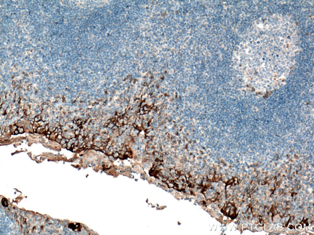 IHC staining of human tonsillitis using 66187-1-Ig