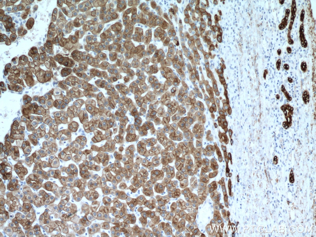 Immunohistochemistry (IHC) staining of human liver cancer tissue using Cytokeratin 18 Monoclonal antibody (66187-1-Ig)