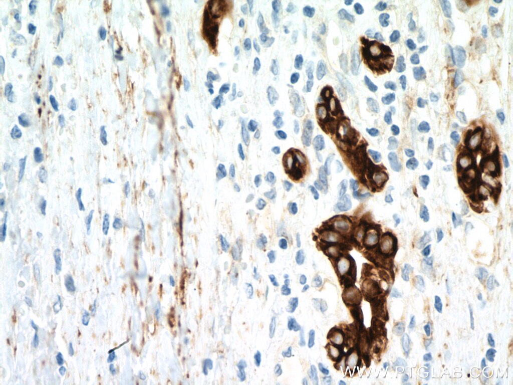 Immunohistochemistry (IHC) staining of human liver cancer tissue using Cytokeratin 18 Monoclonal antibody (66187-1-Ig)