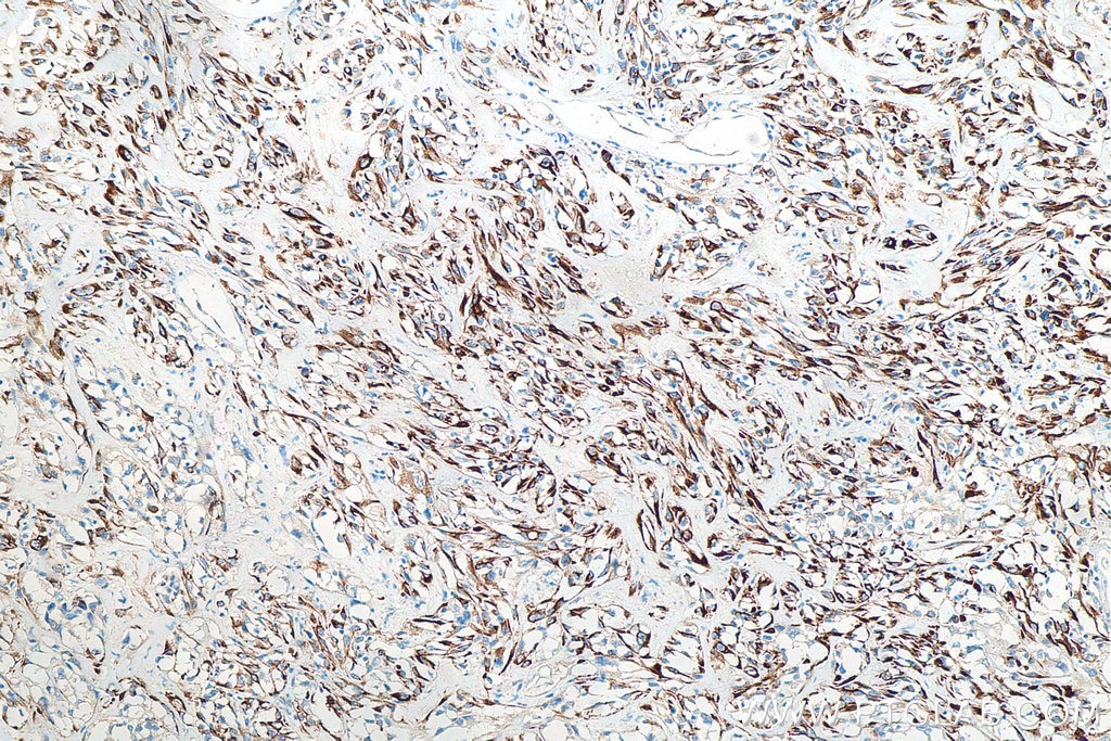 Immunohistochemistry (IHC) staining of human renal cell carcinoma tissue using Cytokeratin 18 Monoclonal antibody (66187-1-Ig)