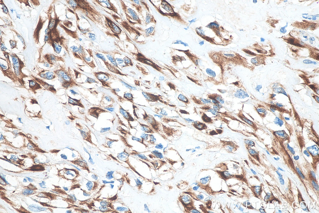 Immunohistochemistry (IHC) staining of human renal cell carcinoma tissue using Cytokeratin 18 Monoclonal antibody (66187-1-Ig)