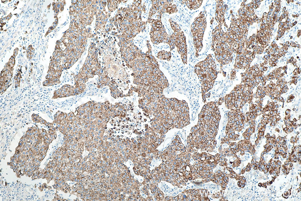 Immunohistochemistry (IHC) staining of human breast cancer tissue using Cytokeratin 18 Monoclonal antibody (66187-1-Ig)