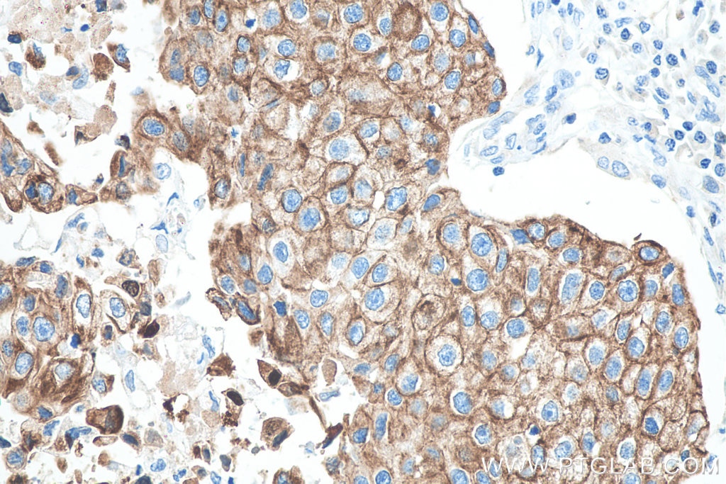 Immunohistochemistry (IHC) staining of human breast cancer tissue using Cytokeratin 18 Monoclonal antibody (66187-1-Ig)