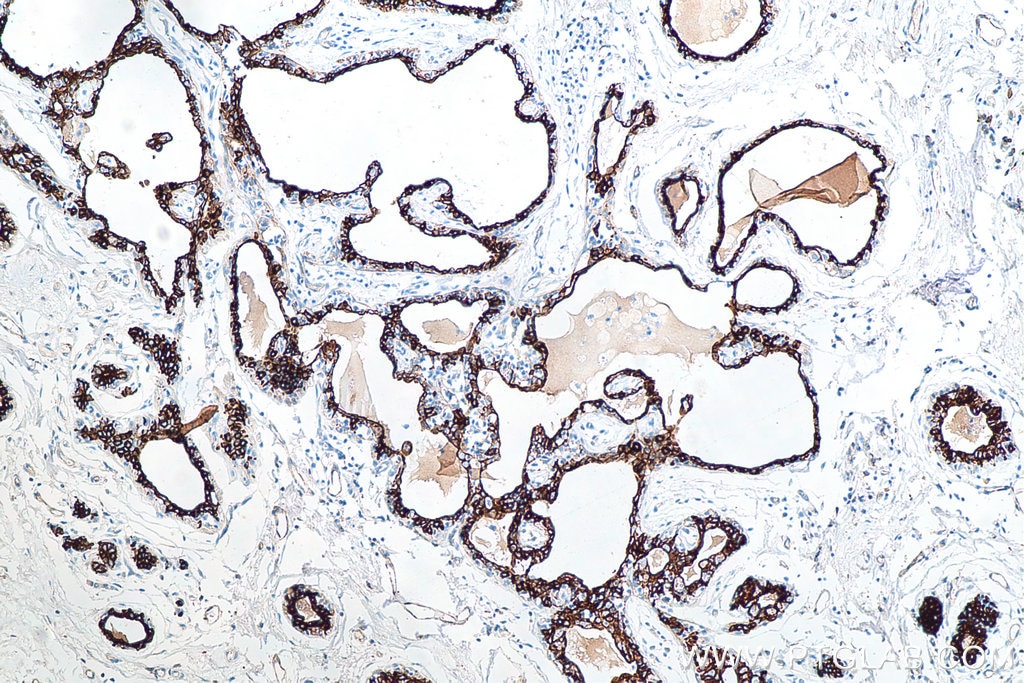 IHC staining of human breast cancer using 66187-1-Ig Immunohistochemistry (IHC) staining of human breast cancer tissue using Cytokeratin 18 Monoclonal antibody (66187-1-Ig)
