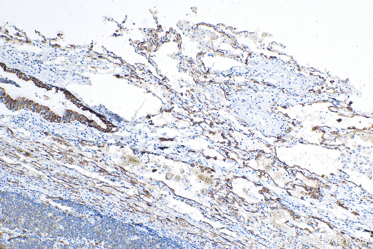 Immunohistochemistry (IHC) staining of human lung cancer tissue using Cytokeratin 18 Monoclonal antibody (66187-1-Ig)