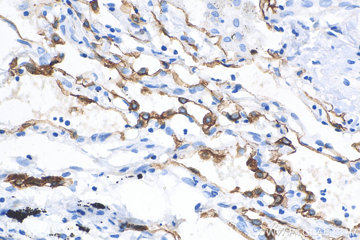 Immunohistochemistry (IHC) staining of human lung cancer tissue using Cytokeratin 18 Monoclonal antibody (66187-1-Ig)